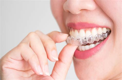 How Long Does Invisalign Take Calgary Sunshine Dental