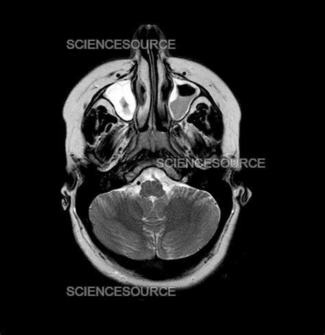 Photograph Mri Of Maxillary Sinusitis Science Source Images