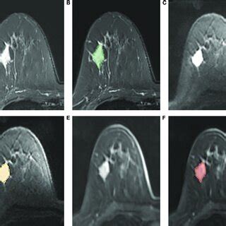 A F An Example Of Manual Segmentation In Breast Cancer A B