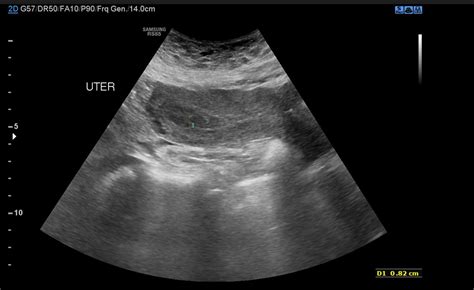 Tubal Ectopic Pregnancy Image