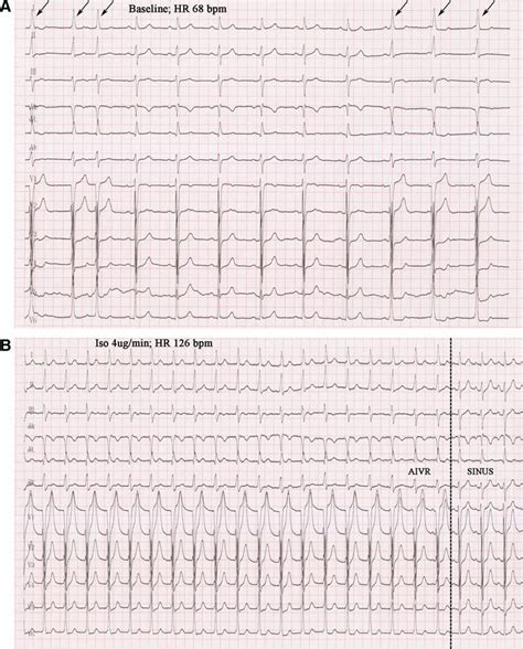 Idiopathic Accelerated Idioventricular Rhythm or Ventricular ...