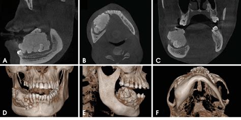 La Tomodensitom Trie Faisceau Conique Cbct Largissant Les