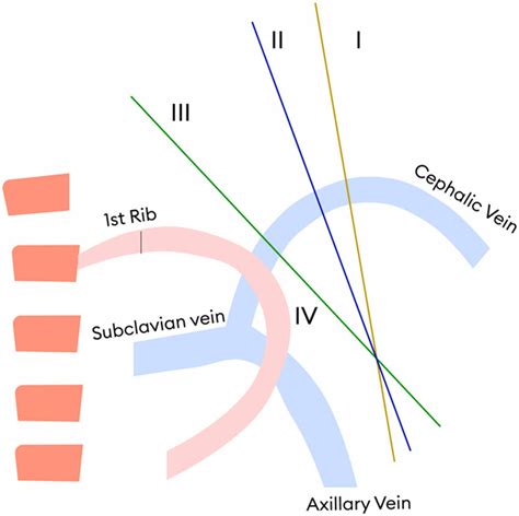 Anatomy of the Cephalic arch. | Download Scientific Diagram