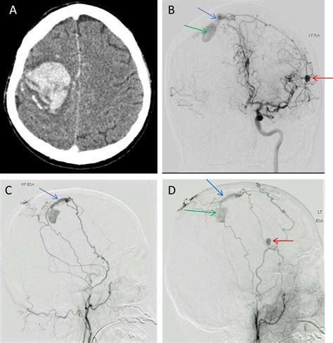 Ct Scan And Cerebral Digital Subtraction Angiography Dsa Upon