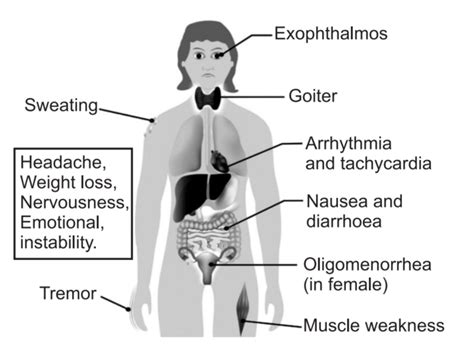 Graves Disease Definition What Is It Symptoms Treatment