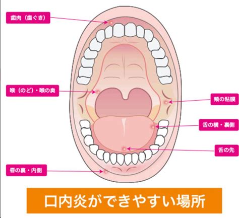 口内炎と口唇ヘルペスの違い｜赤羽の歯医者｜赤羽歯科赤羽診療所