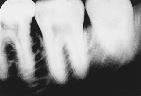 Chapter 6 Dental X Ray Image Characteristics Dental Radiography