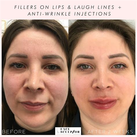 Nurse Cheskas Aesthetic Treatment Lip Filler Near Me Aesthetic Fillers