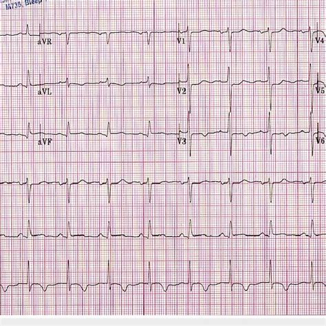 Coronary angiogram shows ostial LAD lesion, wraparound LAD artery, and ...