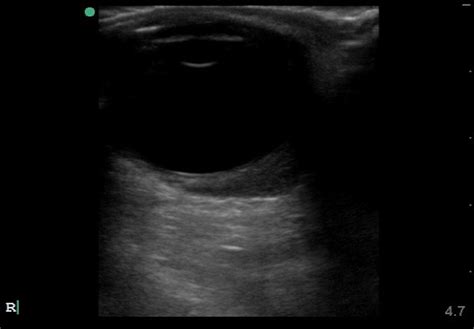 Figure Retrobulbar Hematoma Ultrasound Image Contributed By Harry J