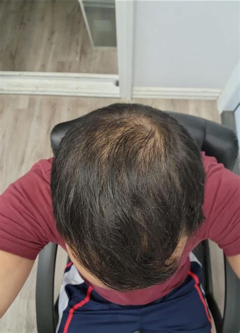 Hermest Hair Transplant 15 Day Results R Hairtransplants