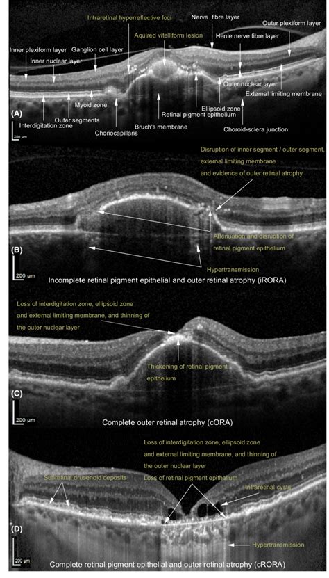 Pathological Findings And Classification Of Atrophy In Drusenoid