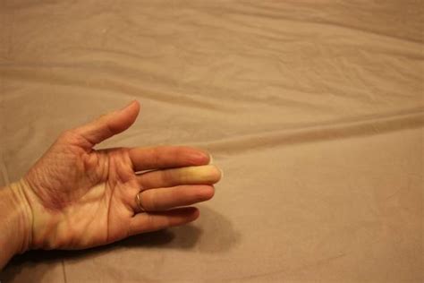 100 Raynauds Syndrome Stock Photos Pictures And Royalty Free Images
