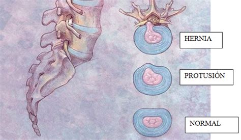 Protusión y hernia discal Osfivel