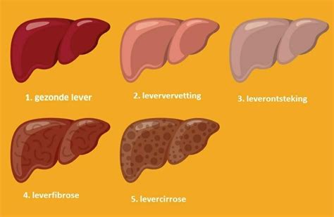 Levercirrose En Alcohol Wat Je Moet Weten Alcoholinfo Nl