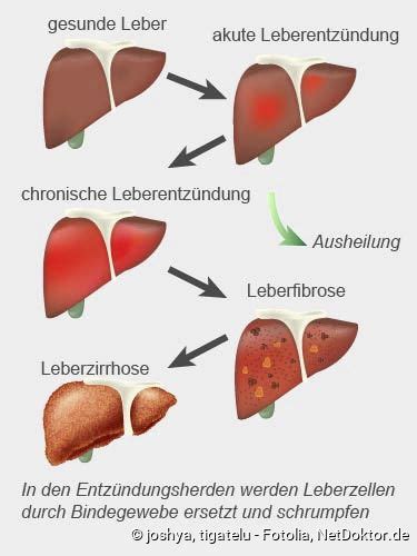 Hepatitis Symptome Ansteckung Netdoktor De