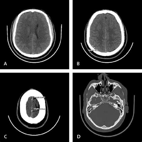 Computed Tomography Brain Axial Cuts Done On The Presentation Of The