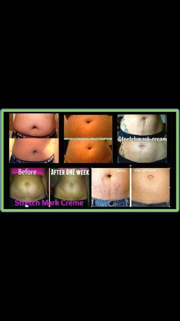 It Works Stretch Mark Cream Email Me Today Alschaff Gmail