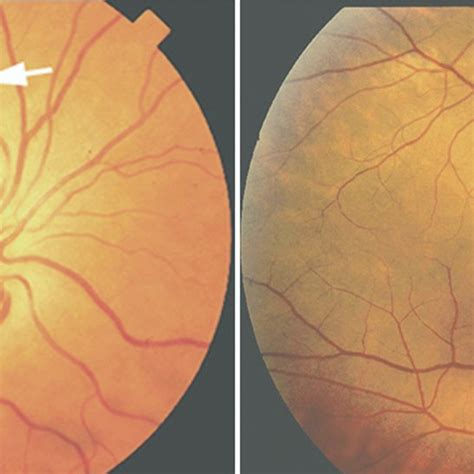 Pdf In Vivo Histology Of Cotton Wool Spots Using High Resolution Optical Coherence Tomography