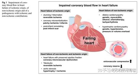 心力衰竭患者的冠状动脉血流：病因、后果和旁观者效应 知乎