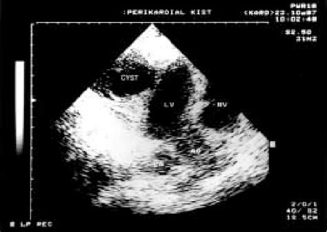 Figure 1 From A Pericardial Hydatid Cyst Masquerading As Acute