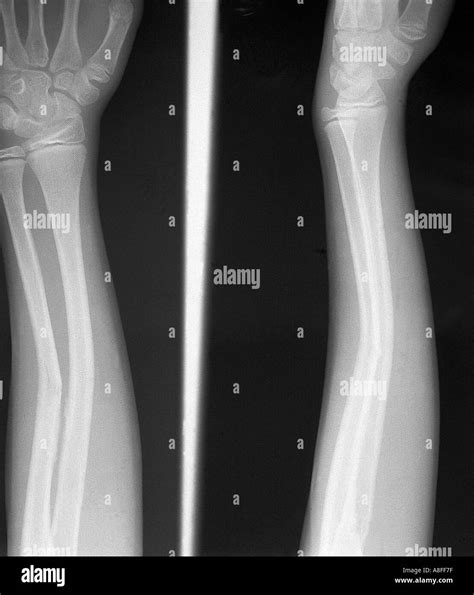 Greenstick Fracture X Ray