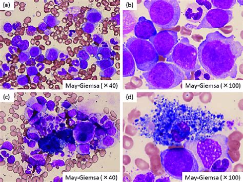 The Patient S Bone Marrow Revealed AML With Monocytic Proliferation