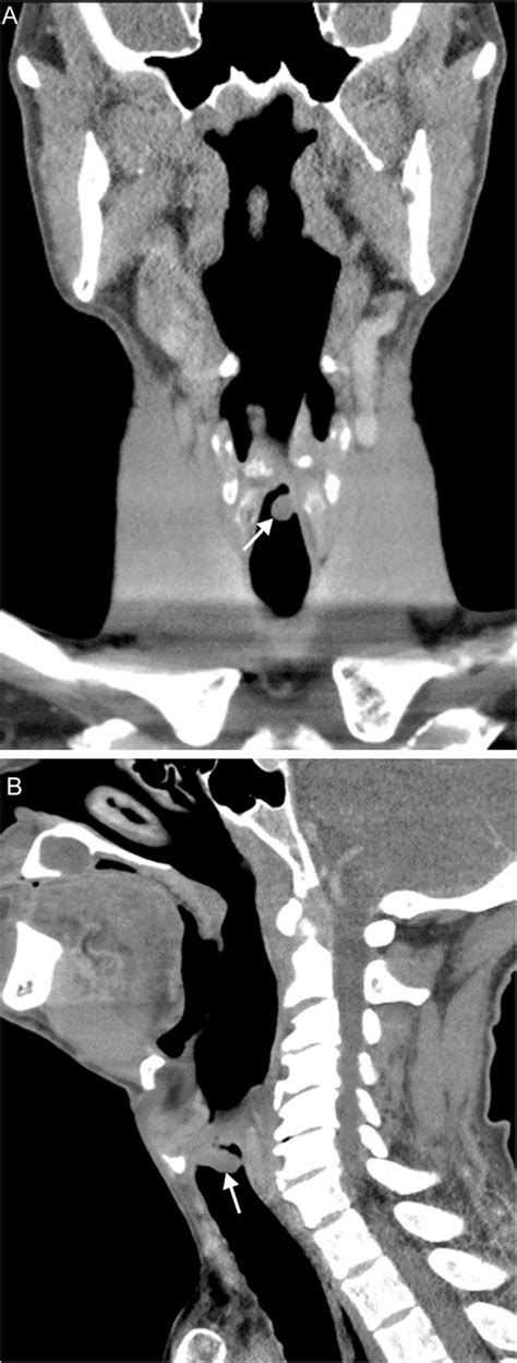 Laryngeal polyp. A 57-year-old man heavy smoker reporting sore throat,... | Download Scientific ...