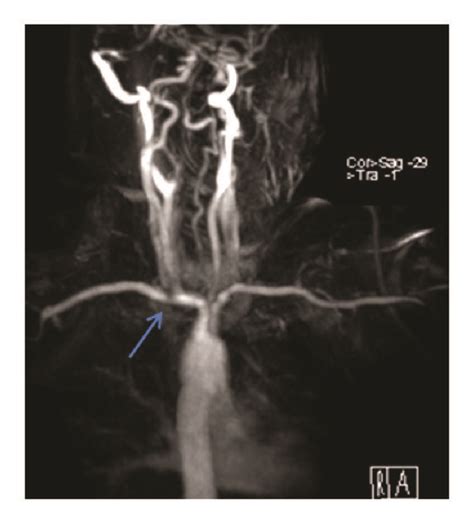 Mri Showing Compression Arrow Of The Right Subclavian Artery Download Scientific Diagram