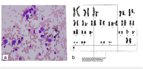 Bone Marrow Biopsy And Karyotype Of Case A Bone Marrow Aspirate