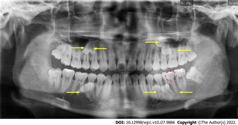 Application Of Digital Positioning Guide Plates For The Surgical