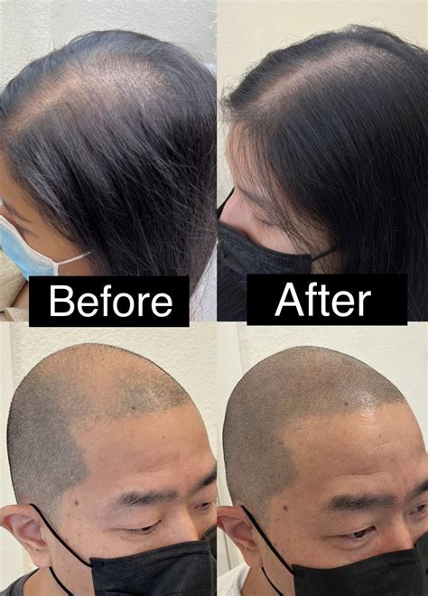 What Is Scalp Micropigmentation — Cosmetat