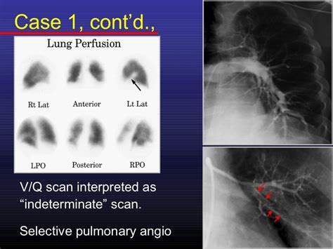 Acute Pulmonary Thromboembolism