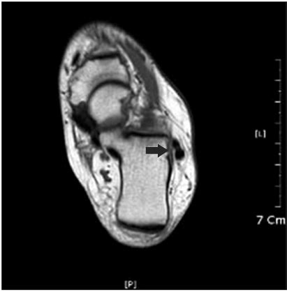 The normal peroneus longus and brevis tendons are observed as a tubular... | Download Scientific ...