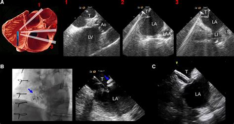 Use Of Intracardiac Echocardiography In Interventional Cardiology