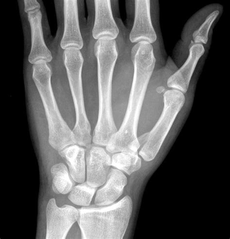 Splinter Series Case Of A First Metacarpal Fracture