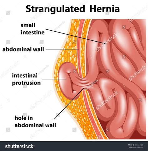 Diagram Inside Strangulated Hernia Stock Vector Royalty Free