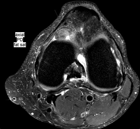 Benoît Rizk On Twitter Infrapatellar Ovoid Mass Would You Call This Localized Nodular