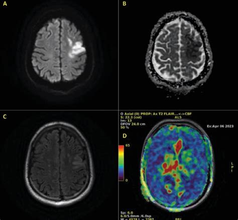 Axial Head Mri Showing A Dwi Sequence Of Hyperintensity On The Left