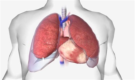 Pleural Effusion Is A Lung Condition Characterized By Fluid Buildup