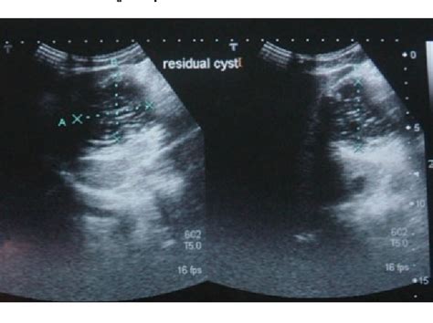 Figure 1 From Successful Treatment Of Hydatid Cyst Of Lesser Sac With Pair Therapy Semantic