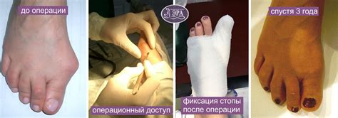Лечение косточки большого пальца | Медицинский центр Эра