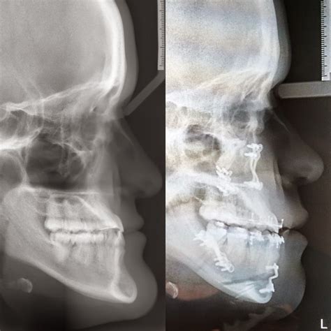 Before And After Braces: X Ray Before And After Braces