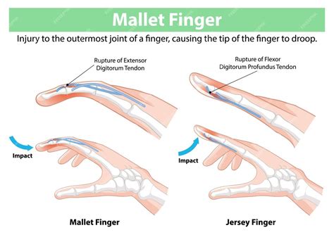 Free Vector Mallet Finger And Jersey Finger