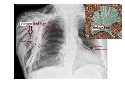 Frontal Chest X Ray Ginkgo Leaf Sign Emergucate