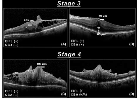 Epiretinal Membrane Oct