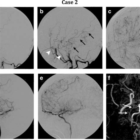 Representative Findings Of Cerebral Angiography In Case 2 A