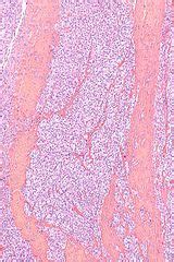 Clear cell sarcoma - Libre Pathology