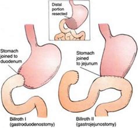 Peptic Ulcer Disease Flashcards Quizlet