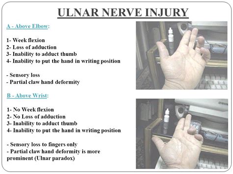 Ulnar Paradox